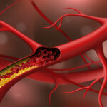 Точніший за холестерин: аналіз, який показує ризик інфаркту та інсульту