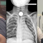 Угорські гроші дістав хірург із горла дитини у м. Рівне: лікар Касько – попереджає (ФОТО/ВІДЕО)